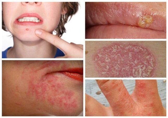 Alergijos ir odos ligos yra parazitų organizme požymiai