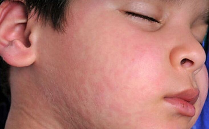 Alerginiai bėrimai ant odos - parazitinių kirminų buvimo organizme simptomas